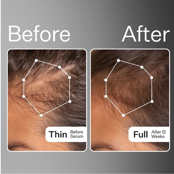 ๐ ACT+ACRE Cold Processed Stem Cell Scalp Serum 30ml - Picture 5 of 12